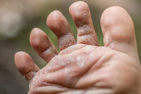 پوسته‌پوسته شدن پا نشانه چیست؟؛ ۱۰ علت شایع و راه‌های پیشگیری