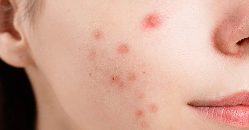 بهترین ضدآفتاب فاقد چربی برای پوست چرب و جوش‌دار..